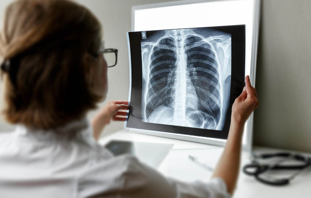 Popcorn Lung Separating Myth From Science VAPEAST Pulse The Beat of